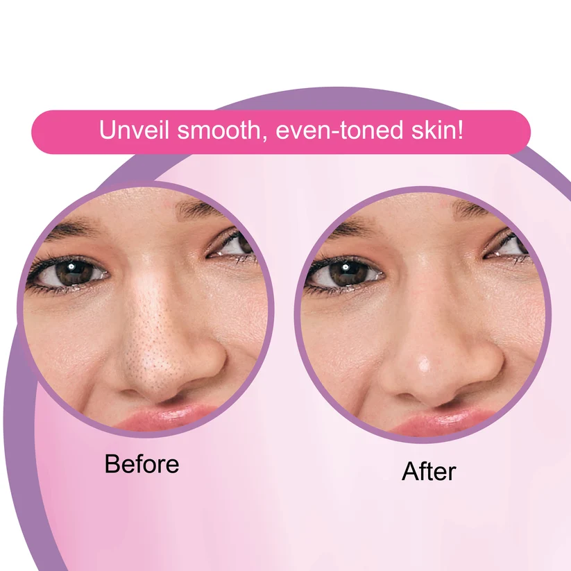 Dr. Rashel White Skin Nose Pore Cleansing Strips (10 Strips) - Blackhead Remover with Niacinamide & Arbutin {Pack of 2} - Image 5
